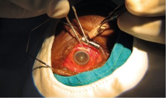An ESU employed in an eye surgery
