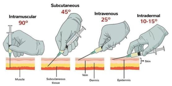 Hypodermic needles being used to deliver angled injections