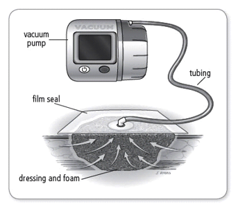 Identifying the Different Types of Wound Drainage ...