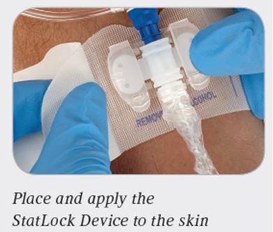 What is the StatLock Stabilization Device and How Does it Work?