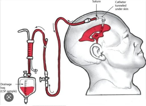 What Are The Benefits Of External Ventricular Drains?