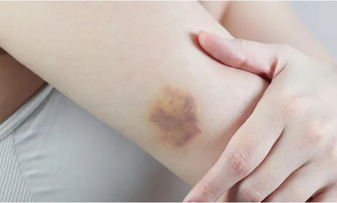 hematoma vs bruise