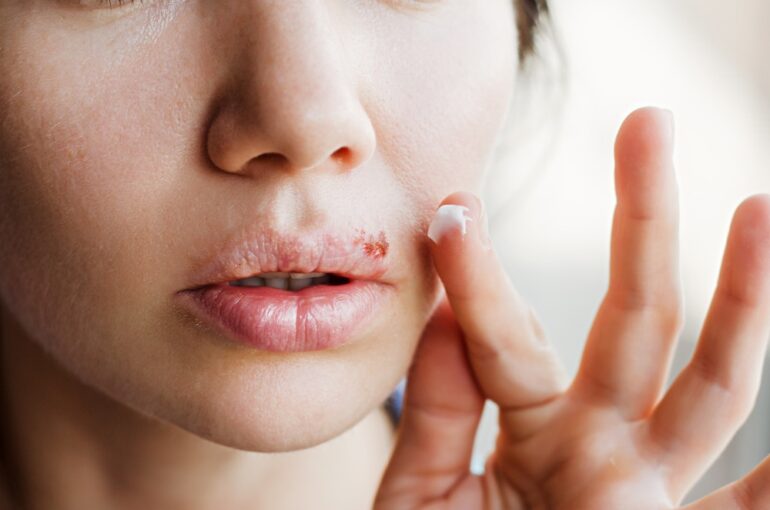 Cold Sore Vs Pimple How To Tell The Difference