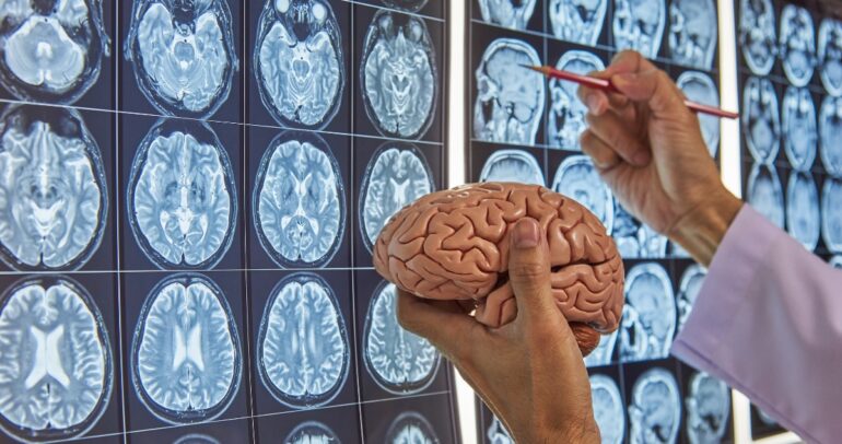 intracerebral hemorrhage area