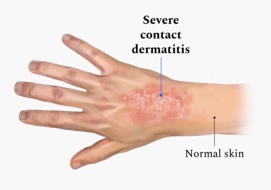 Severe Contact dermatitis