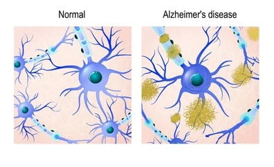 healthy and affected neurons by Alzheimer's