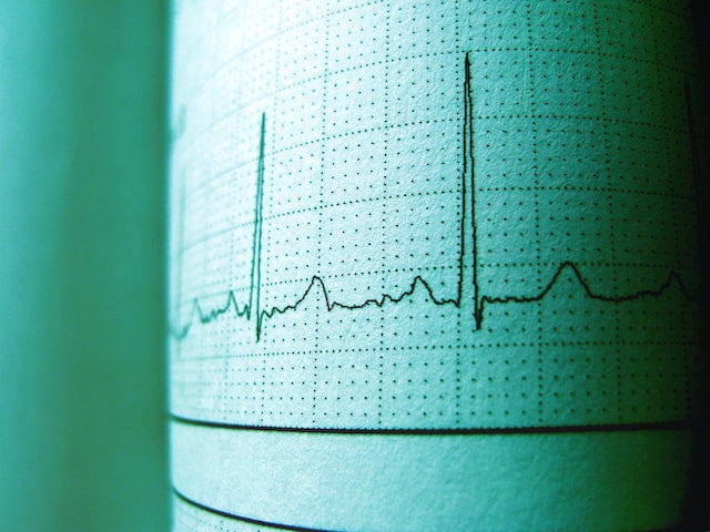 Cardiac rhythmic activity displayed after electrocardiography