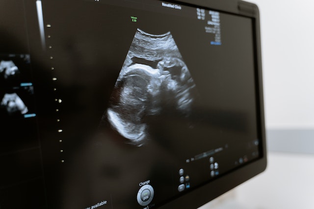 A 3D image created by an ultrasound scanner