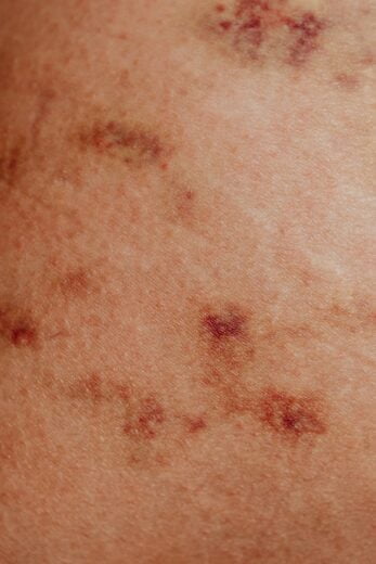 Skin redness which might be an indication of Merkel cell carcinoma