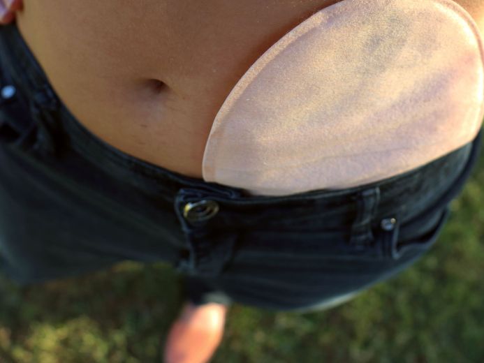 A woman wearing an ostomy bag without any discomfort or irritation