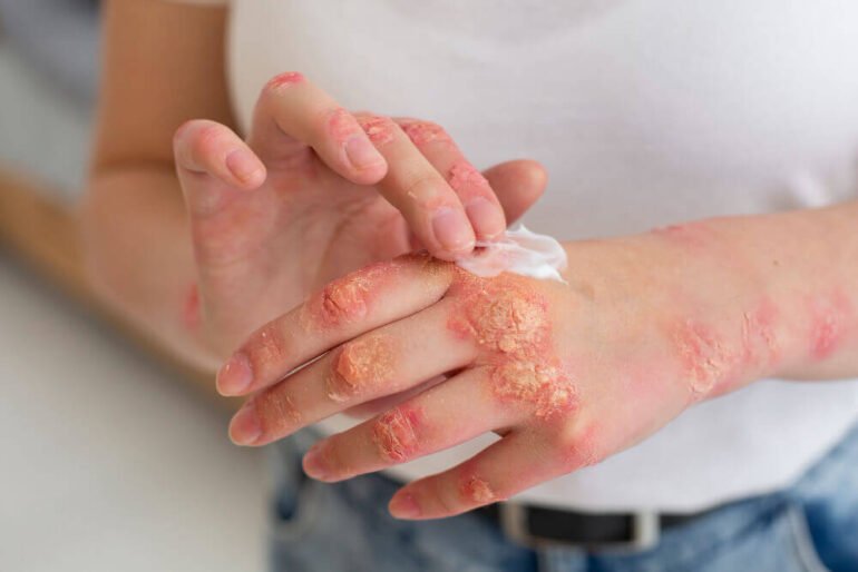 Skin inflammation is also reduced with the use of topical antibiotics