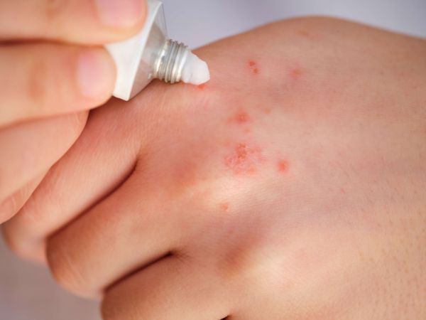 The use of bacitracin zinc ointment for minor wounds