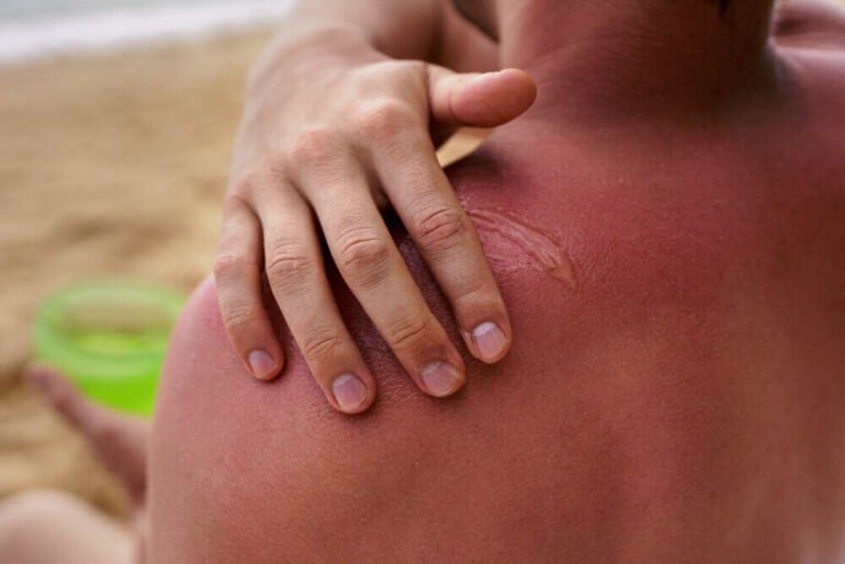 Bacitracin zinc ointment used in sunburn helps relieve the affected area quickly