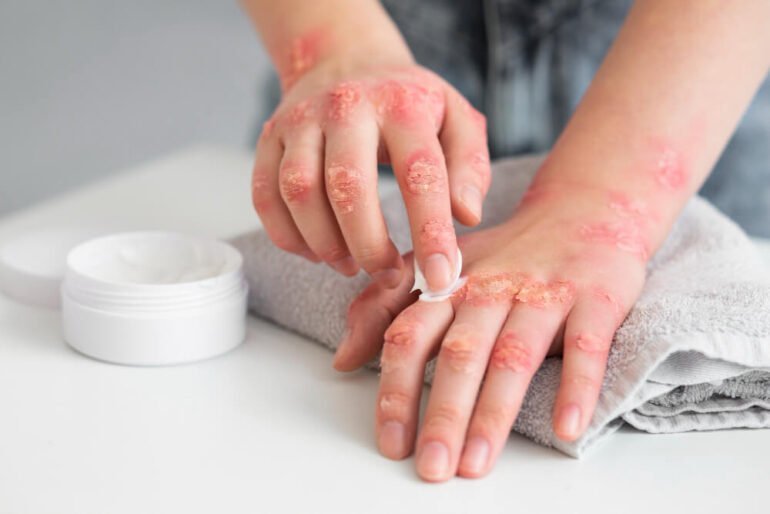 Topical antibiotics can treat multiple kinds of skin disorders