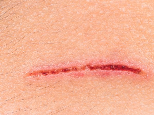 Suture kit vs surgical staplers are both effective against deep-tissue wounds