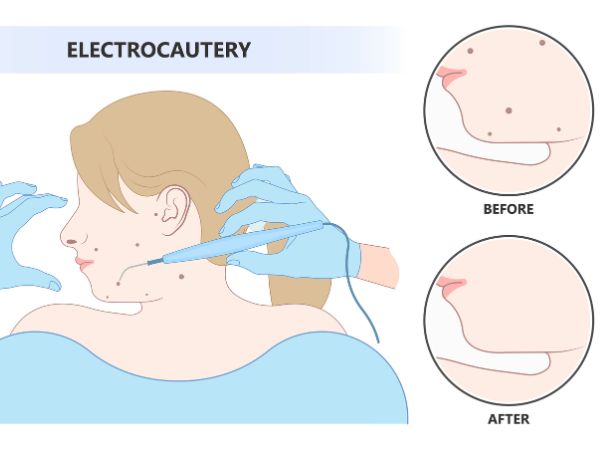 The use of ConMed Hyfrecator 2000 for skin treatment is a common practice