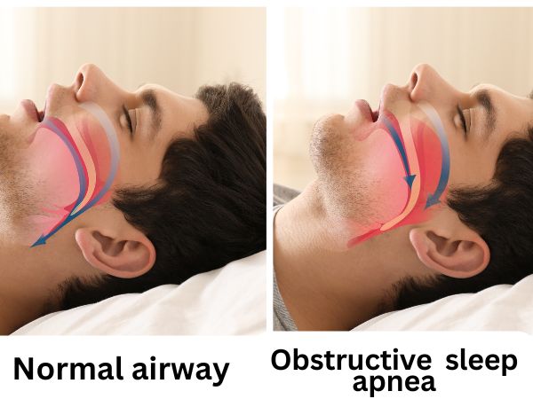 The AutoSet technology in ResMed AirSense 11 can effectively manage obstructive sleep apnea