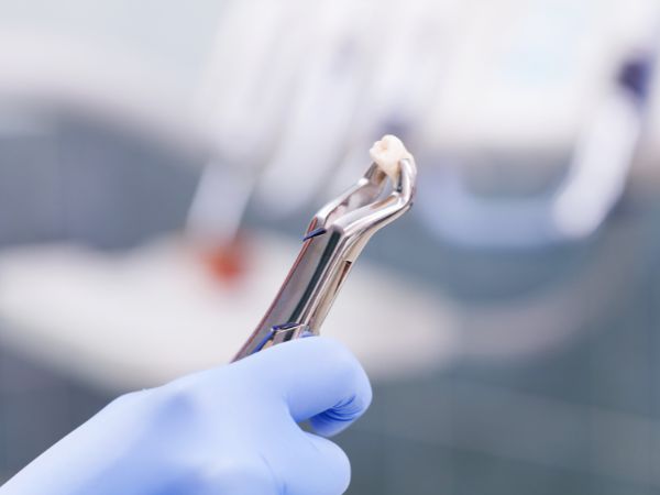 Dental forceps are being employed for dental procedures