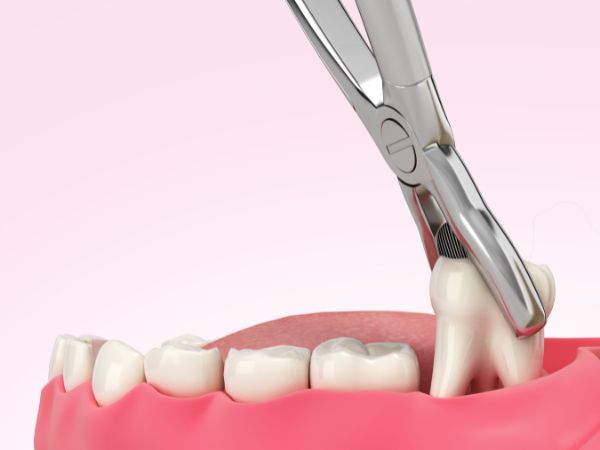 The molar is being removed using dental forceps suited for three-rooted tooth extraction