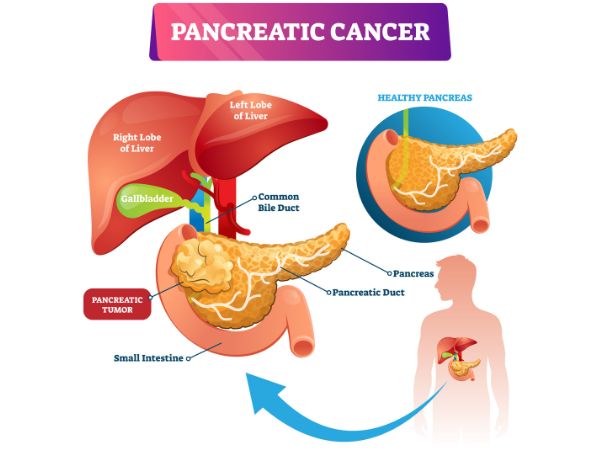 Pancreatic cancers change the structure and function of the pancreas