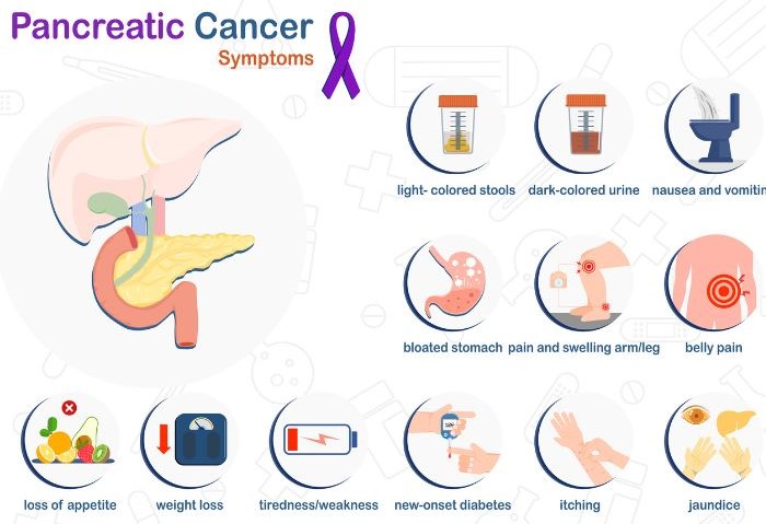 Symptoms of exocrine pancreatic cancer