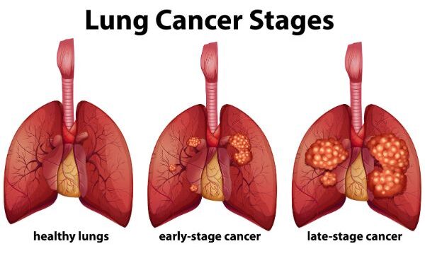 A comparison of healthy lungs with cancerous lungs