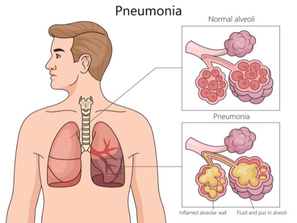 A comparison of normal alveoli vs pus-filled alveoli during bacterial and viral pneumonia