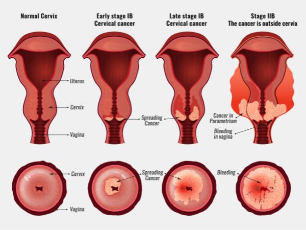 A comparison of normal and abnormal or cancerous cervical tissue