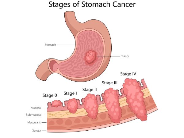 Different stages of stomach cancer are treated with different surgical techniques