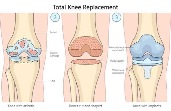 Knee replacement surgery