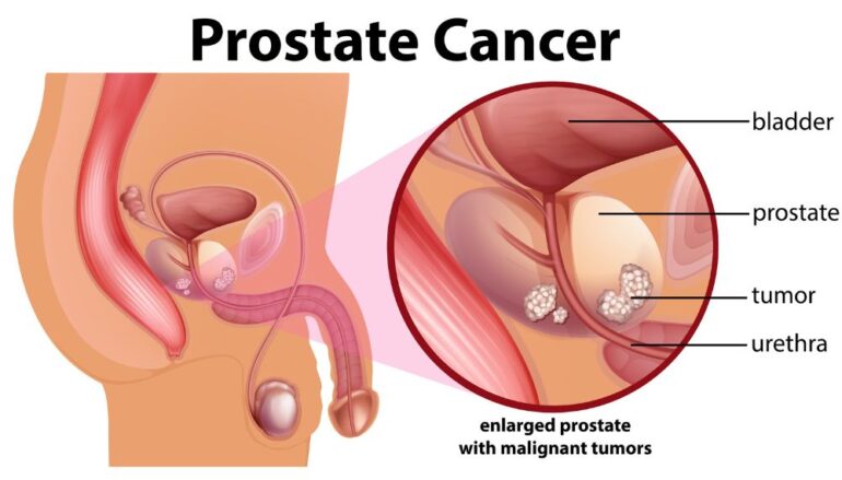 Localized prostate cancer cells can be targeted with proton beam therapy