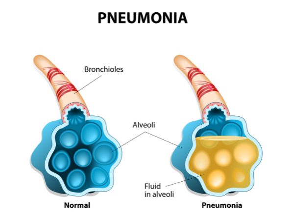 Lungs affected with pneumonia have pus-filled alveoli