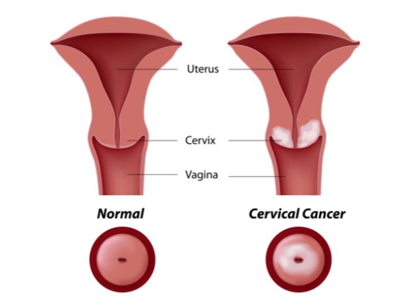 Normal cervical cells vs. cancerous cervical tissue