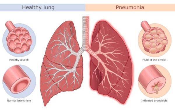 Normal lungs vs pneumonic lungs