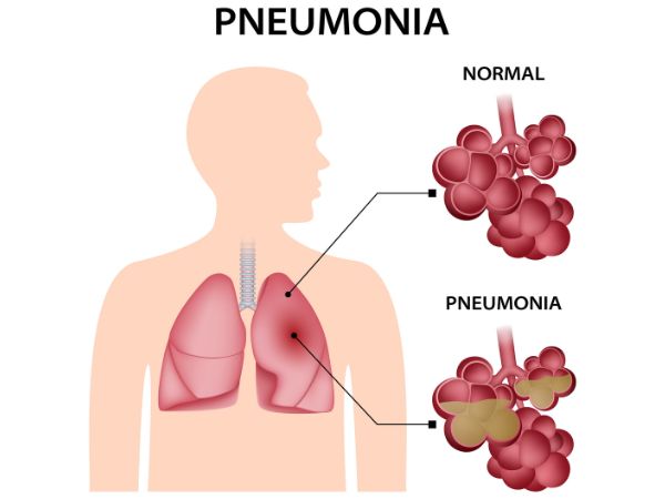 Pus is visible in the alveoli of patients with severe pneumonia