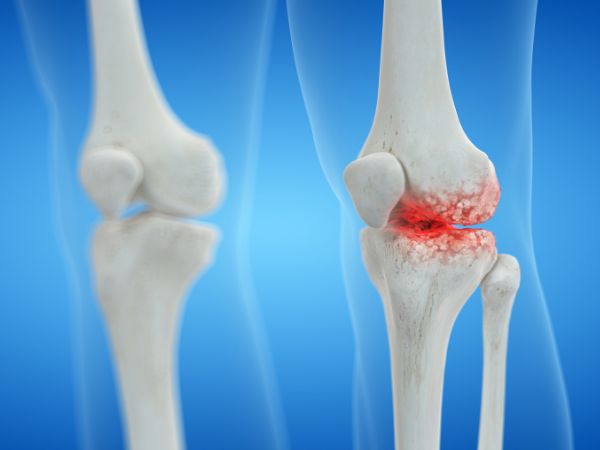 The arthritic knee has damaged and deteriorating connective tissue