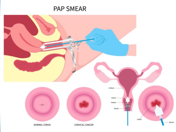 Pap smear and colposcopic examination indicate the health of the vaginal and cervical tissue