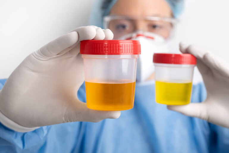 A fresh sample should be collected each time before conducting a urine test