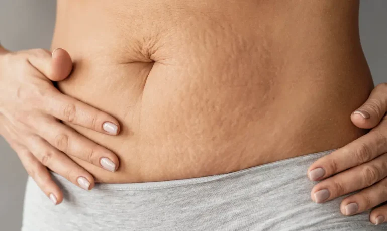 Cellulite is associated with fat and fluid deposition in the skin