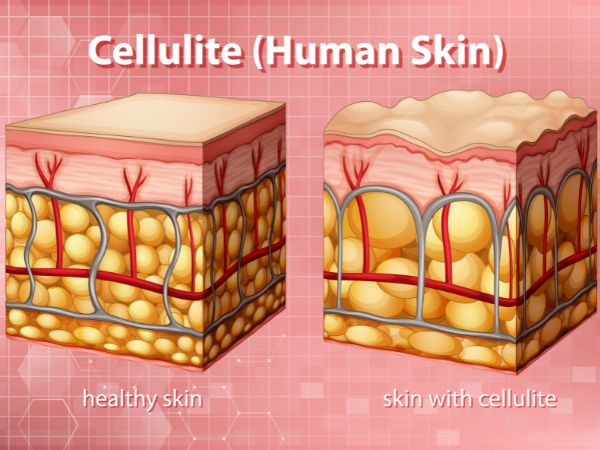 Cellulite makes the skin look looser and aged
