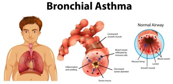 Narrowing of the airways causes a hindrance in the natural breathing process Narrowing of the airways causes a hindrance in the natural breathing process