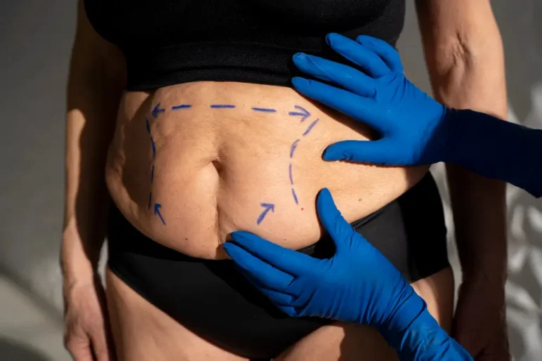 Surgical procedures are also available for the permanent removal of cellulite