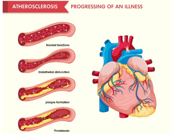 Atherosclerosis is associated with the deposition of fat in the blood vessels