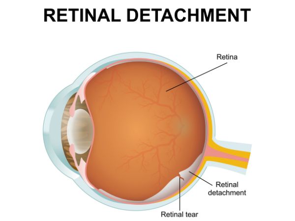 A timely eye examination helps diagnose retinal damage in its earlier stages